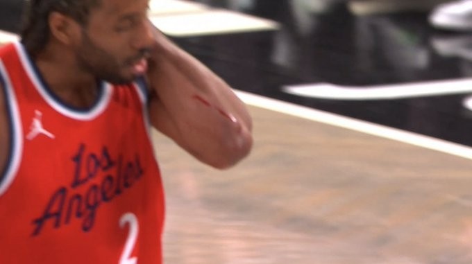 觸目驚心！小卡手臂被劃出一道長長的血痕 去場邊及時止血處理